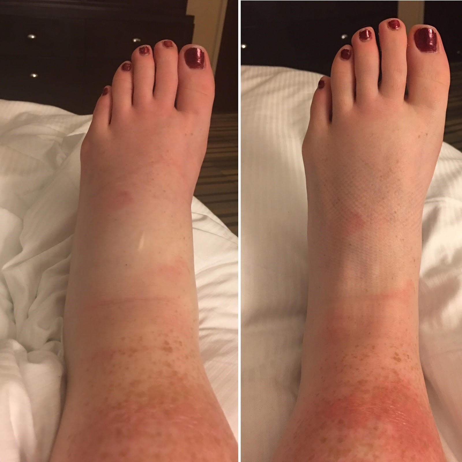 Incrediwear ankle inflammation before and after